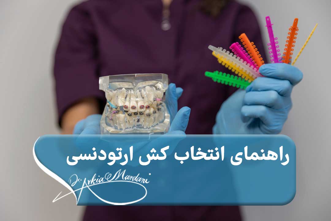 کش ارتودنسی چیست